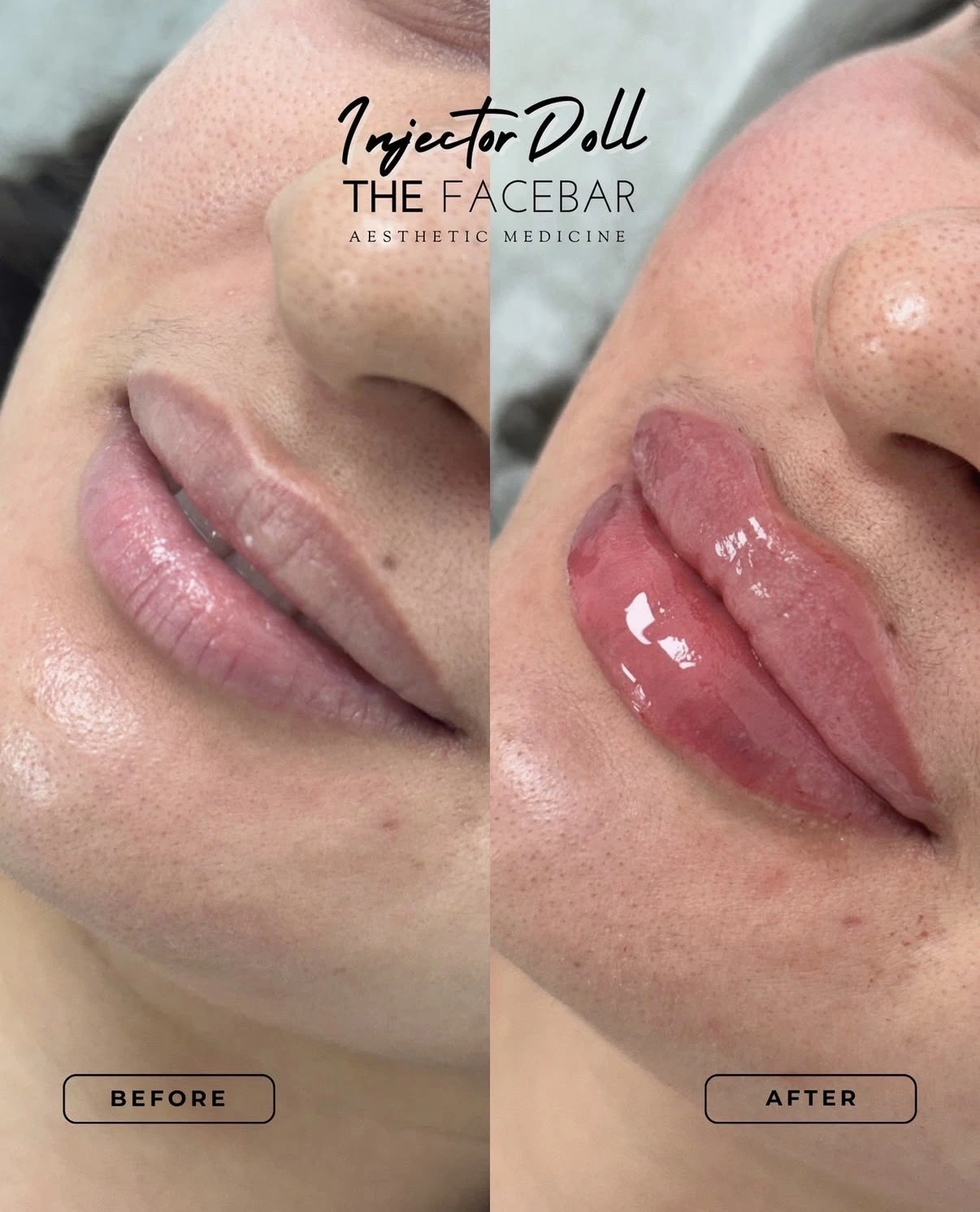 Lip Filler before & after