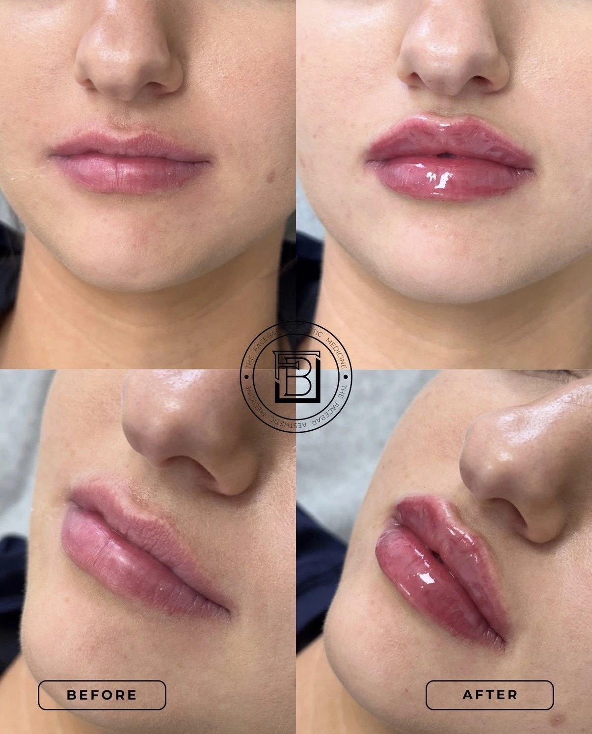 Lip Filler before & after