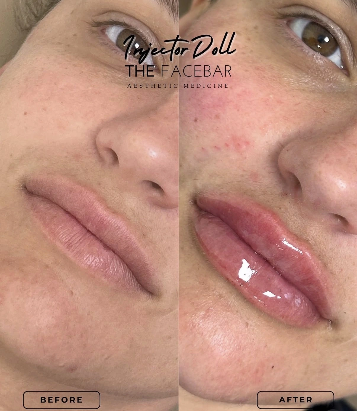 Lip Filler before & after