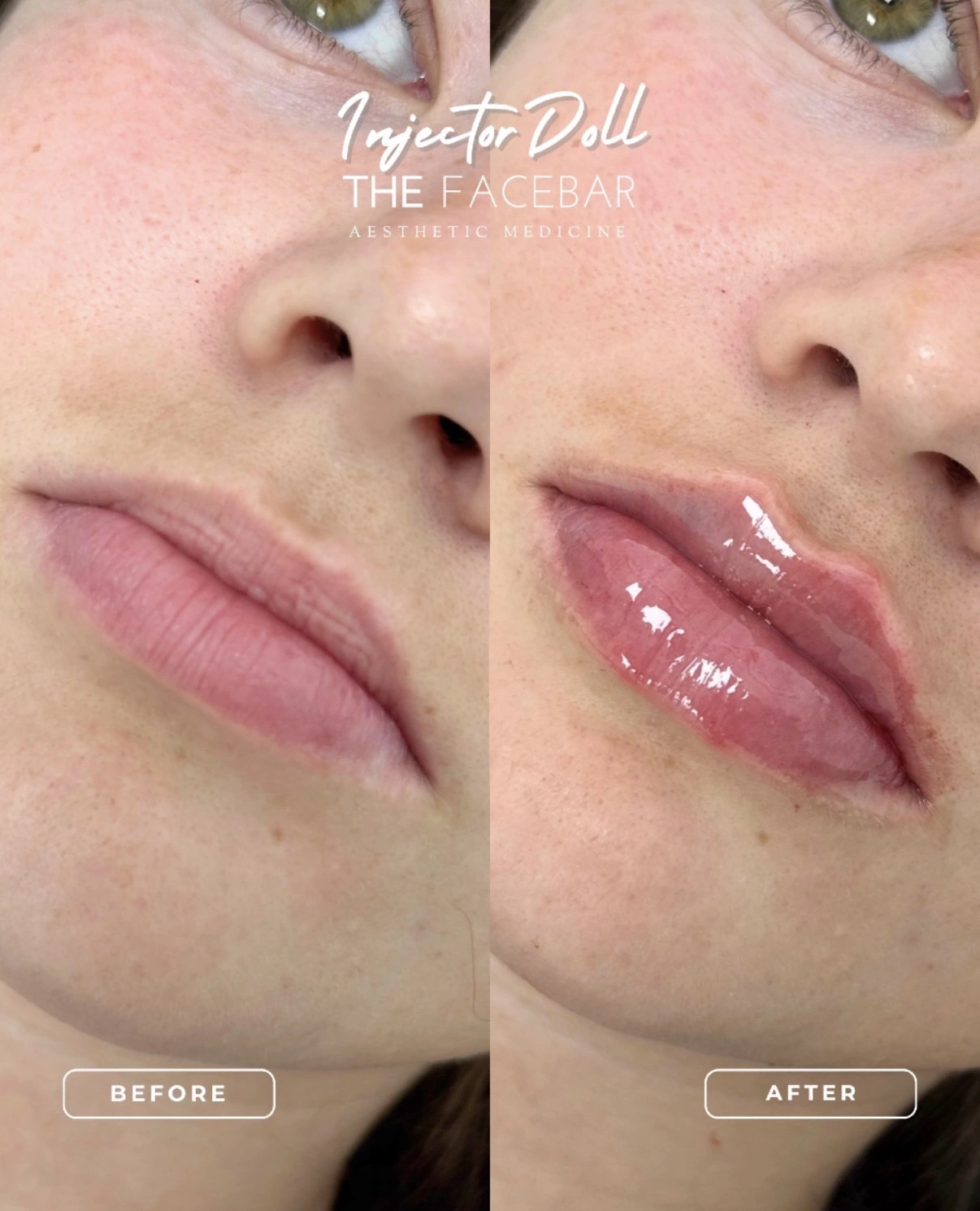 Lip Filler before & after